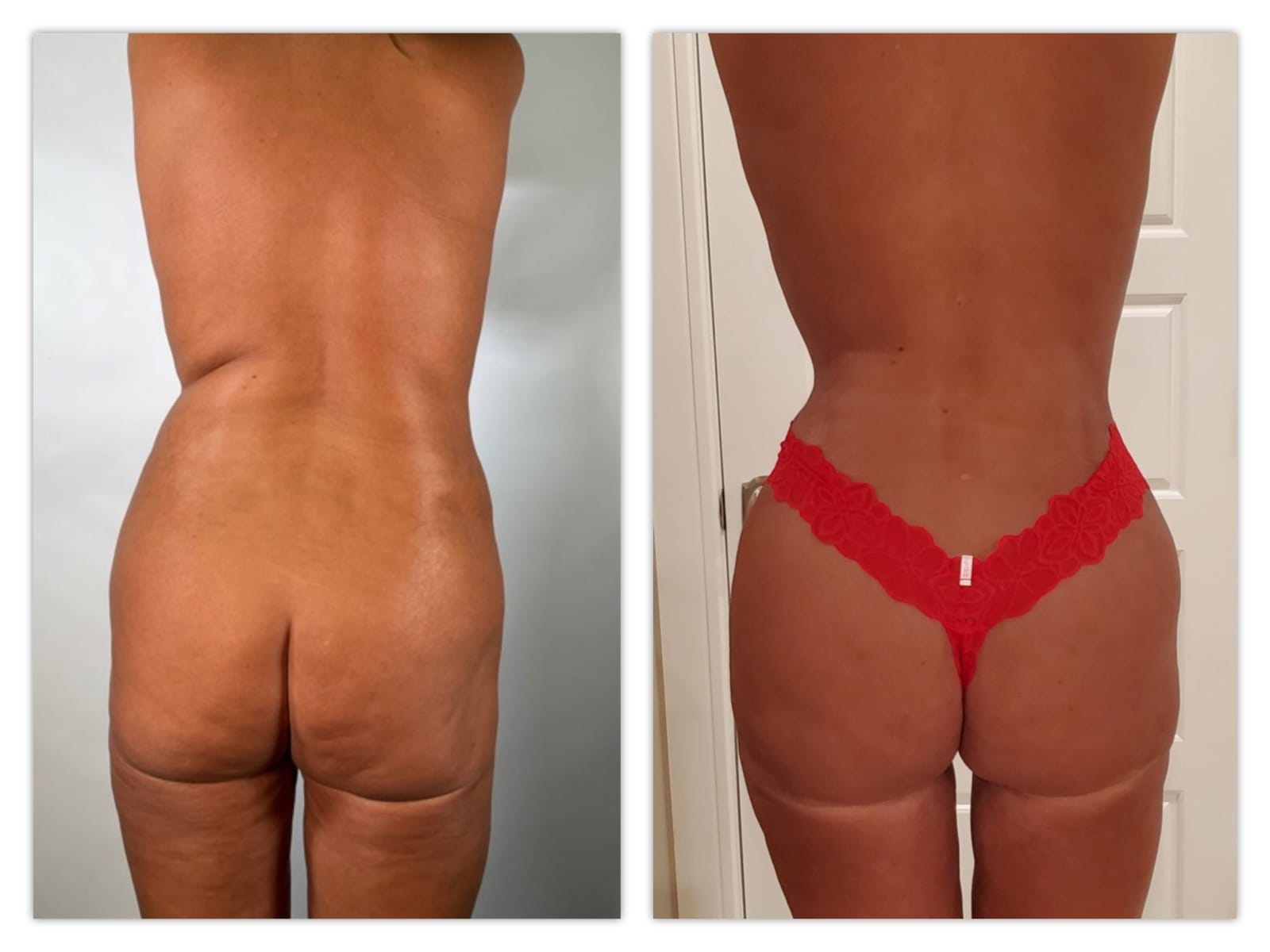 Brazilian Butt Lift Before & After Gallery - Patient 133213887 - Image 1