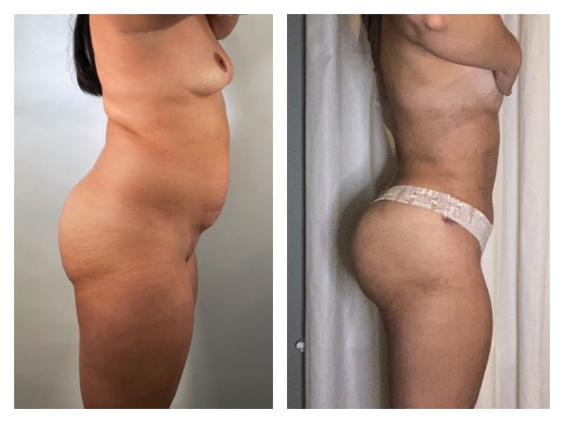 Brazilian Butt Lift Before & After Gallery - Patient 133183787 - Image 3