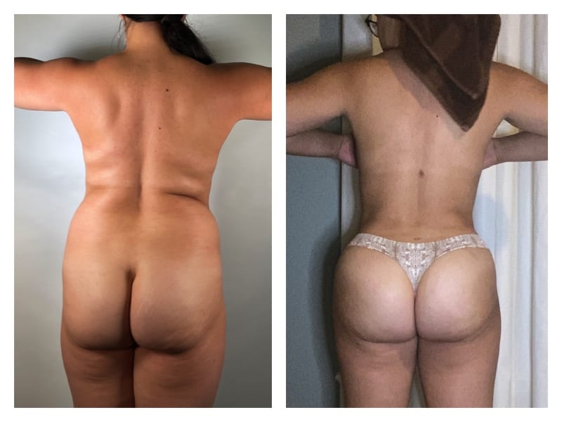 Brazilian Butt Lift Before & After Gallery - Patient 133183787 - Image 1