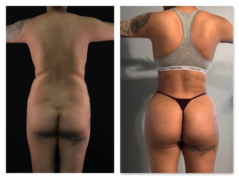 Brazilian Butt Lift Before & After Gallery - Patient 133183814 - Image 1