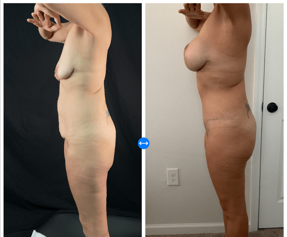 Mommy Makeover Before & After Gallery - Patient 133183632 - Image 4