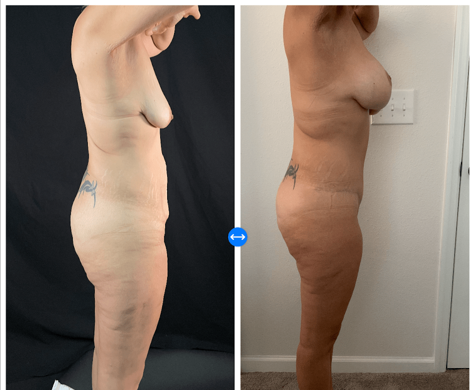 Mommy Makeover Before & After Gallery - Patient 133183632 - Image 3