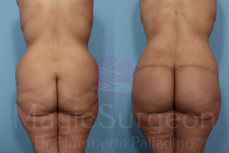 Body Contouring Before & After Gallery - Patient 133182285 - Image 5