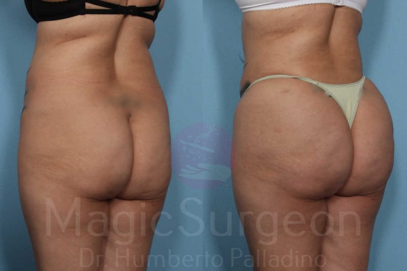 Brazilian Butt Lift Before & After Gallery - Patient 133182290 - Image 3