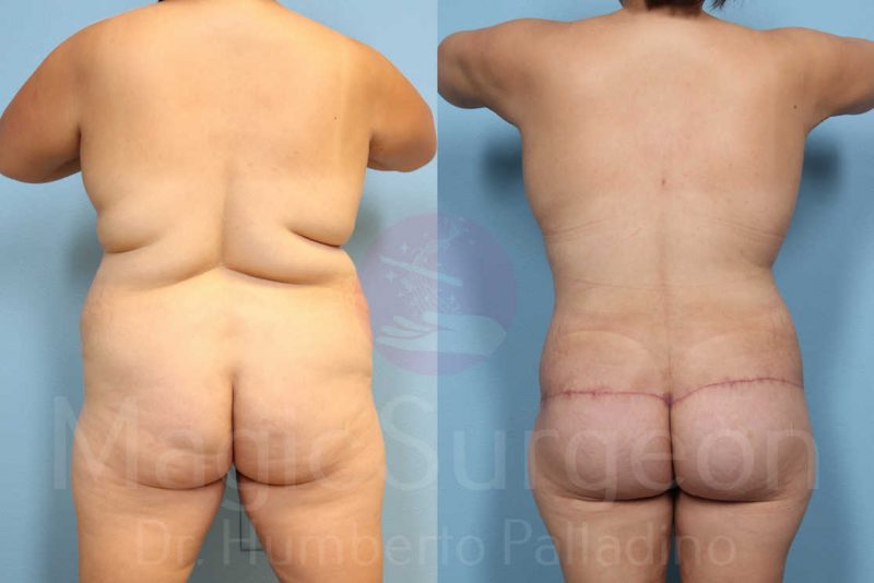 Body Contouring Before & After Gallery - Patient 133182292 - Image 5