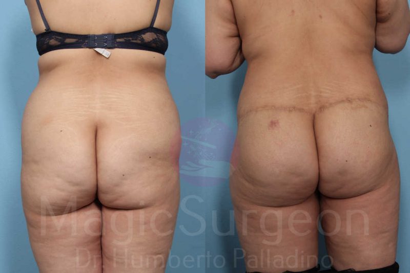 Brazilian Butt Lift Before & After Gallery - Patient 143542653 - Image 1