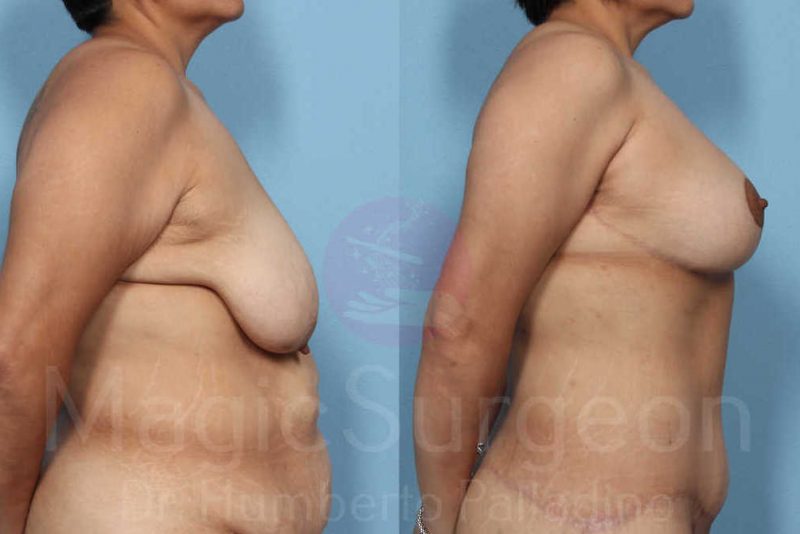 Mommy Makeover Before & After Gallery - Patient 133182320 - Image 3