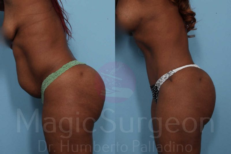 Tummy Tuck Before & After Gallery - Patient 133182321 - Image 4