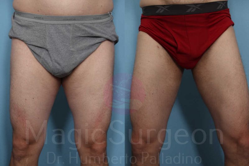 Liposuction Before & After Gallery - Patient 133182328 - Image 6