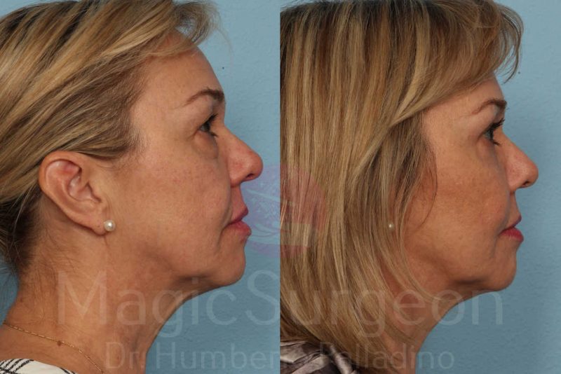 Blepharoplasty Before & After Gallery - Patient 133182331 - Image 5