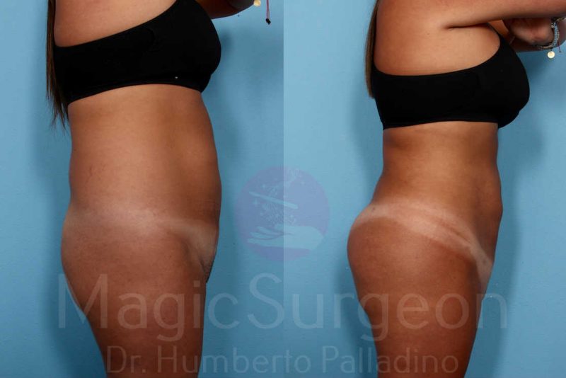 Liposuction Before & After Gallery - Patient 133182333 - Image 2