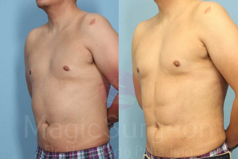 Liposuction Before & After Gallery - Patient 133182342 - Image 2