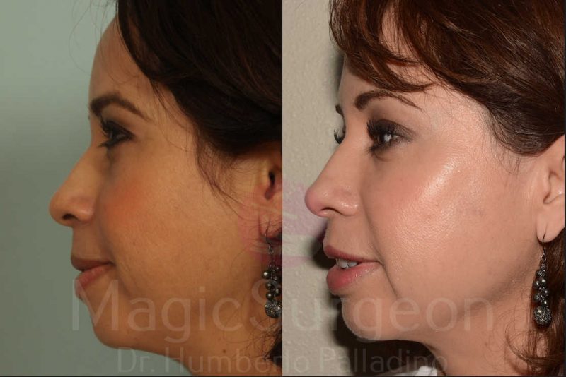 Fat Injections Before & After Gallery - Patient 133182353 - Image 3