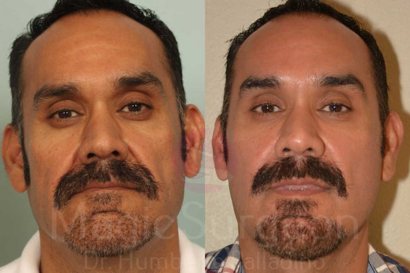 Facelift Before & After Gallery - Patient 133182362 - Image 1