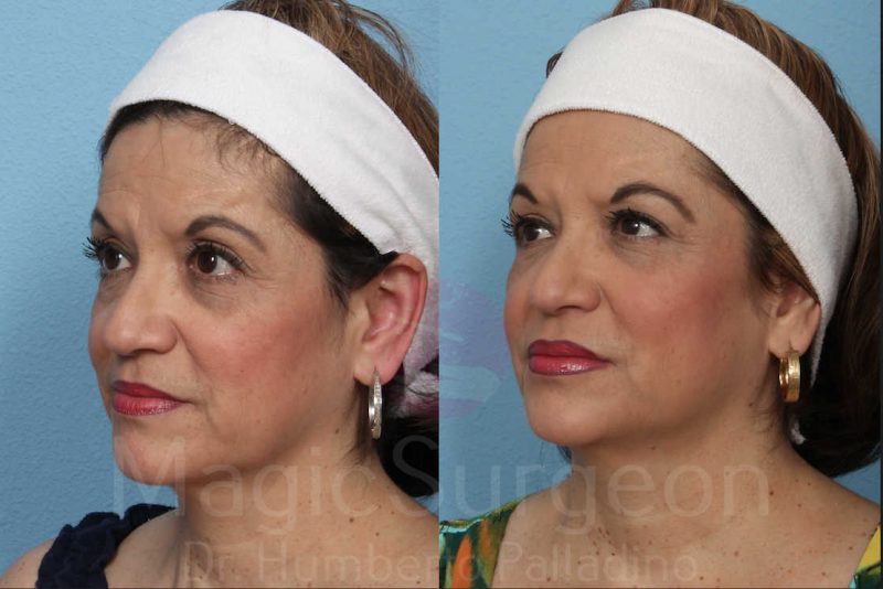 Fat Injections Before & After Gallery - Patient 133182363 - Image 2