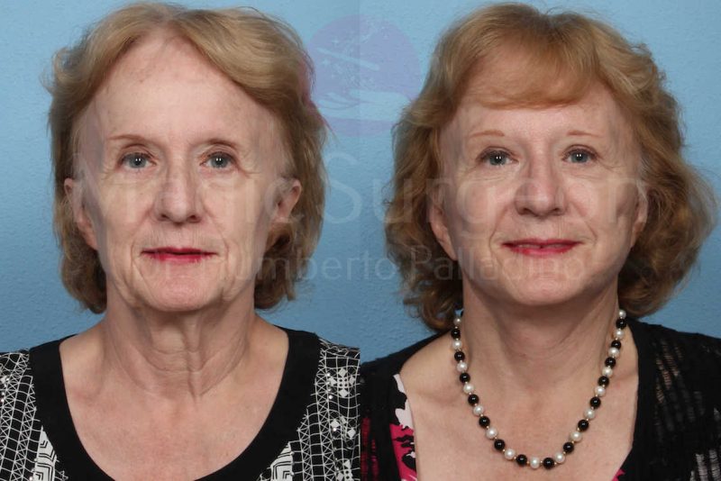 Neck Lift Before & After Gallery - Patient 133182365 - Image 1