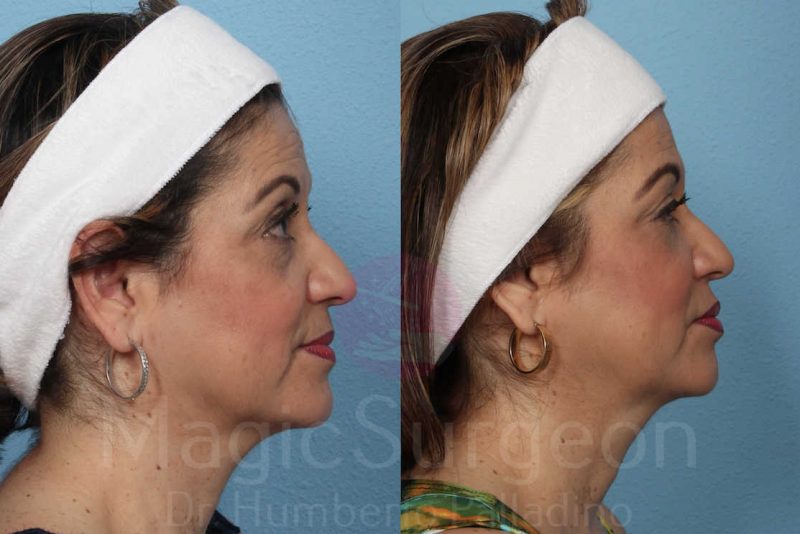 Fat Injections Before & After Gallery - Patient 133182363 - Image 5