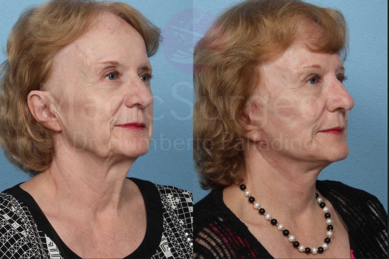 Neck Lift Before & After Gallery - Patient 133182365 - Image 4