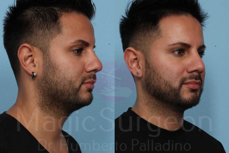 Rhinoplasty Before & After Gallery - Patient 133182406 - Image 4