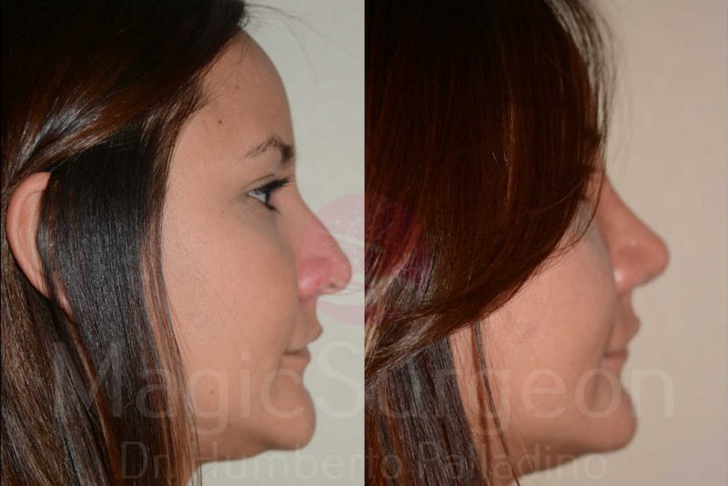 Rhinoplasty Before & After Gallery - Patient 133182409 - Image 4