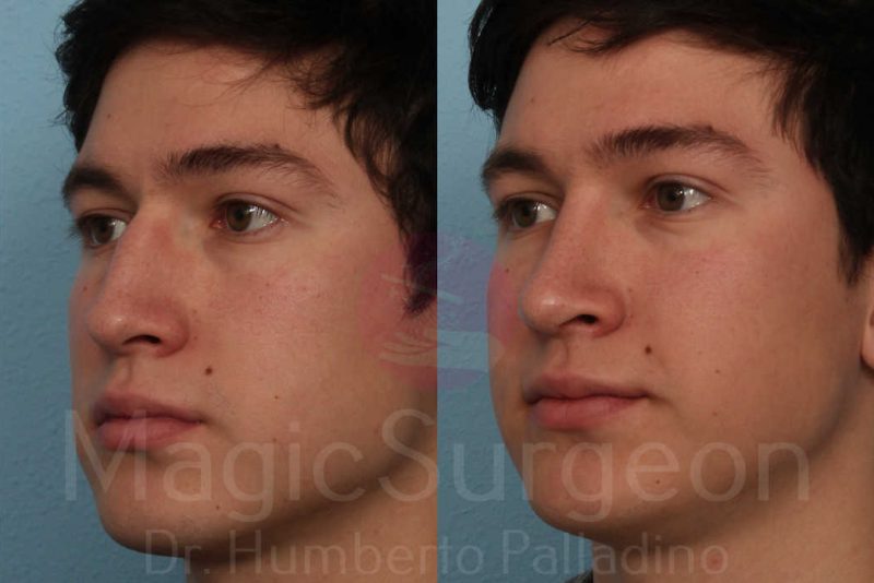 Rhinoplasty Before & After Gallery - Patient 133182411 - Image 2