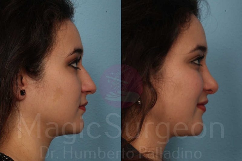 Rhinoplasty Before & After Gallery - Patient 133182415 - Image 5