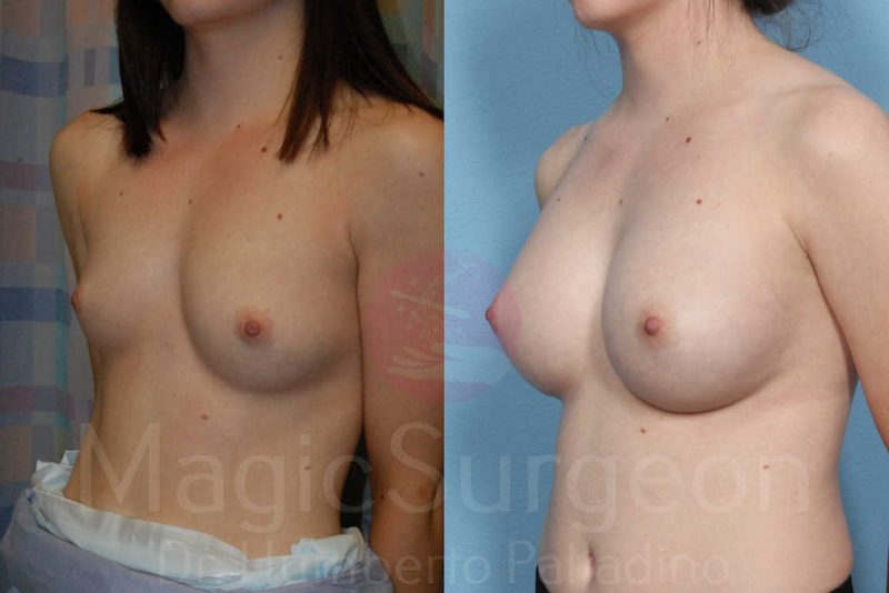 Breast Augmentation Before & After Gallery - Patient 133182424 - Image 2