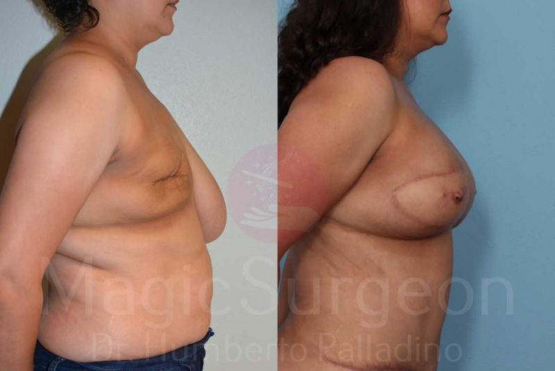 Breast Reconstruction Before & After Gallery - Patient 133182428 - Image 3