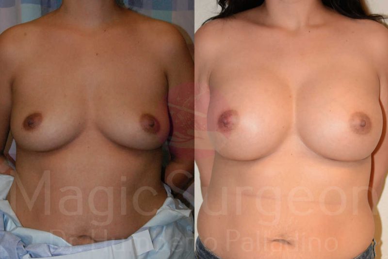 Breast Augmentation Before & After Gallery - Patient 133182463 - Image 1