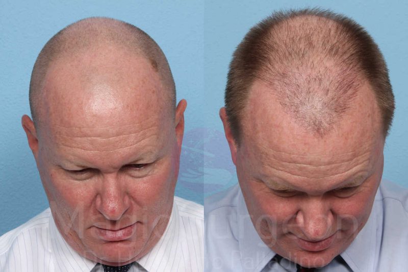 Hair Transplant Before & After Gallery - Patient 133182461 - Image 2