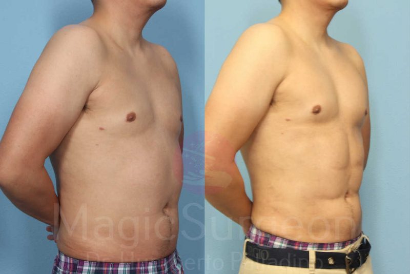 Male HD Liposculpture Before & After Gallery - Patient 133182470 - Image 4