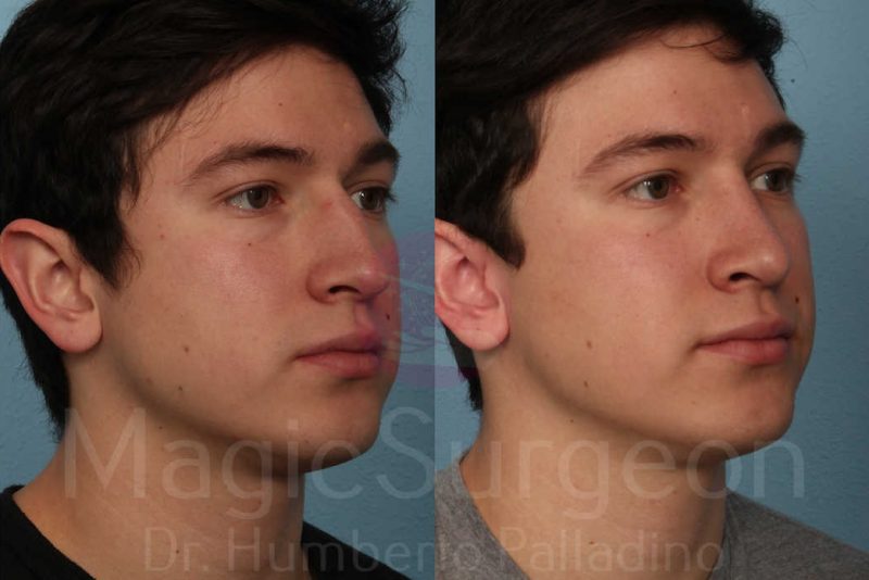 Men's Rhinoplasty Before & After Gallery - Patient 133182473 - Image 4