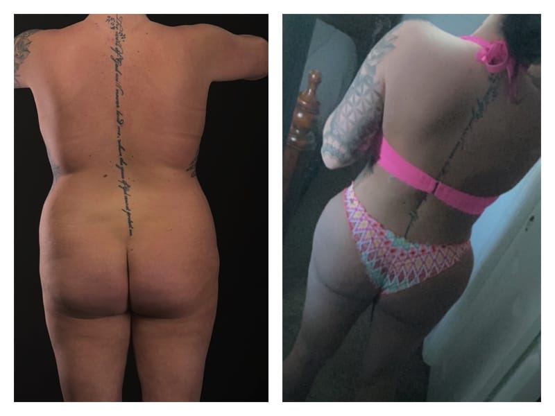 Tummy Tuck Before & After Gallery - Patient 133183855 - Image 3