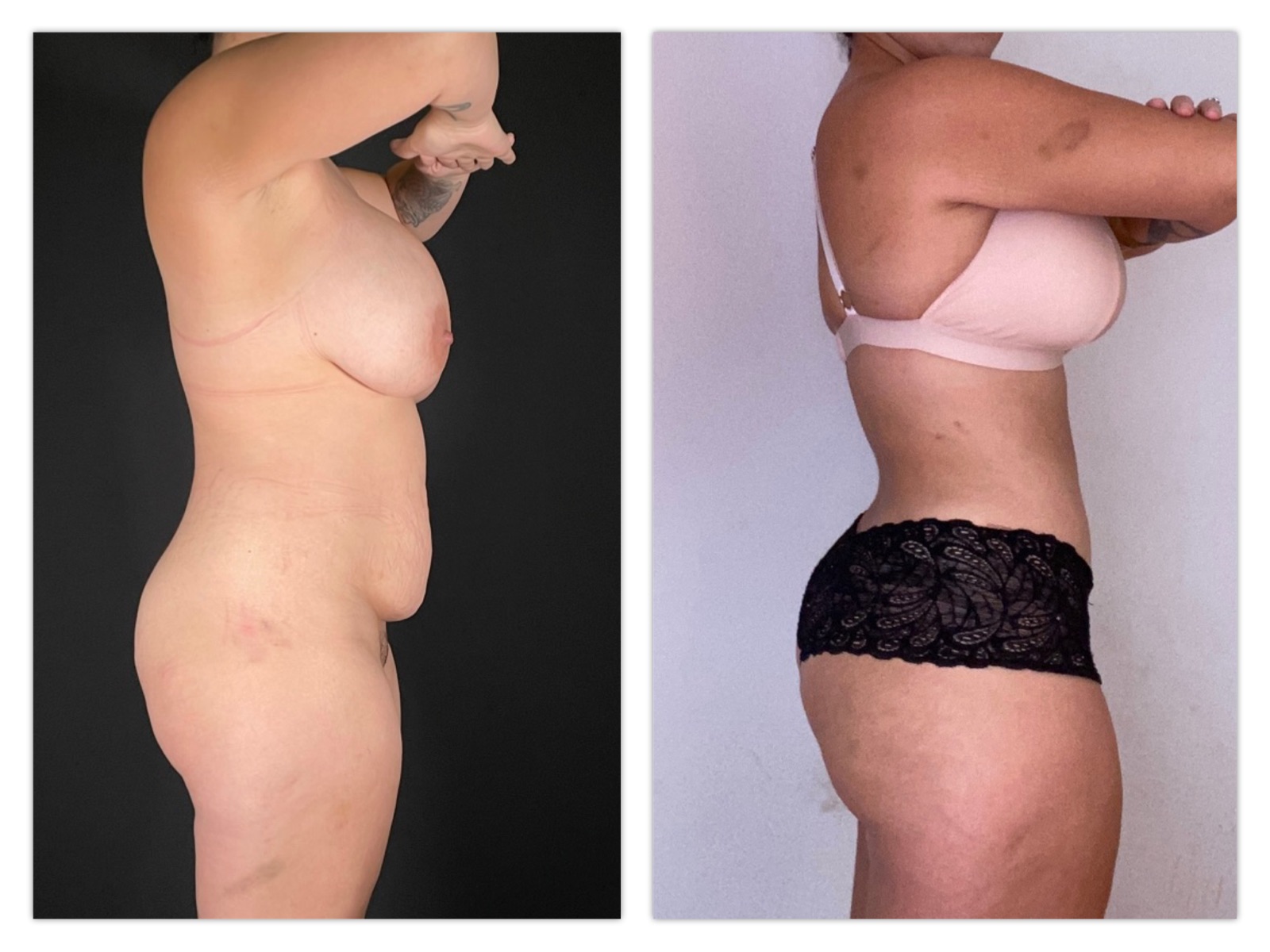 Brazilian Butt Lift Before & After Gallery - Patient 175515021 - Image 1