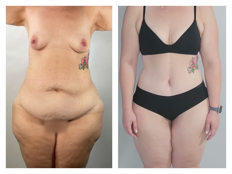 Liposuction Before & After Gallery - Patient 175515125 - Image 1