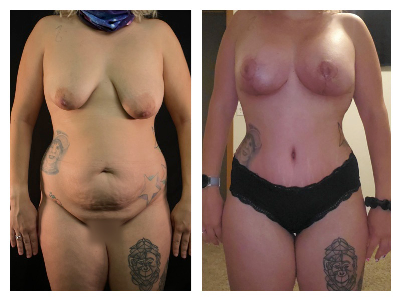 Tummy Tuck Before & After Gallery - Patient 175518050 - Image 1