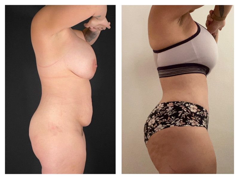 Tummy Tuck Before & After Gallery - Patient 175518042 - Image 1