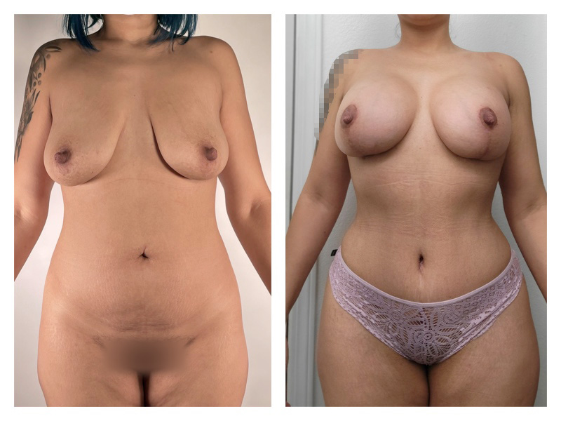 Tummy Tuck Before & After Gallery - Patient 175518040 - Image 1