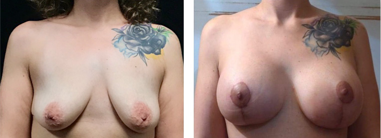 Breast Augmentation Before & After Gallery - Patient 175518065 - Image 1