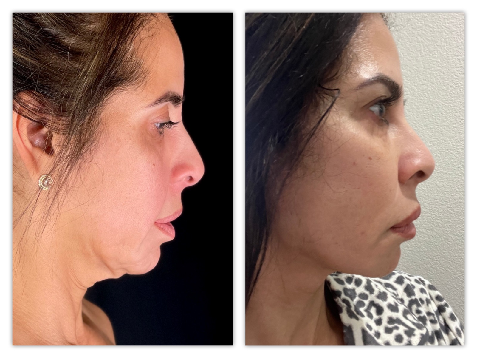 Facelift Before & After Gallery - Patient 415529 - Image 1