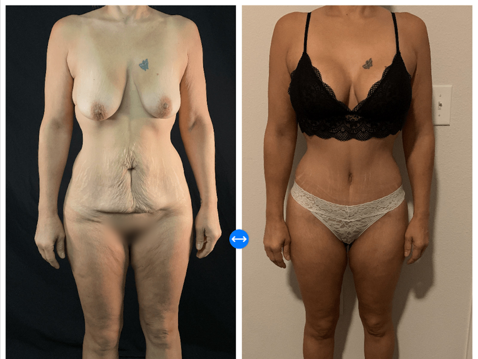 Mommy Makeover Before & After Gallery - Patient 133183632 - Image 1