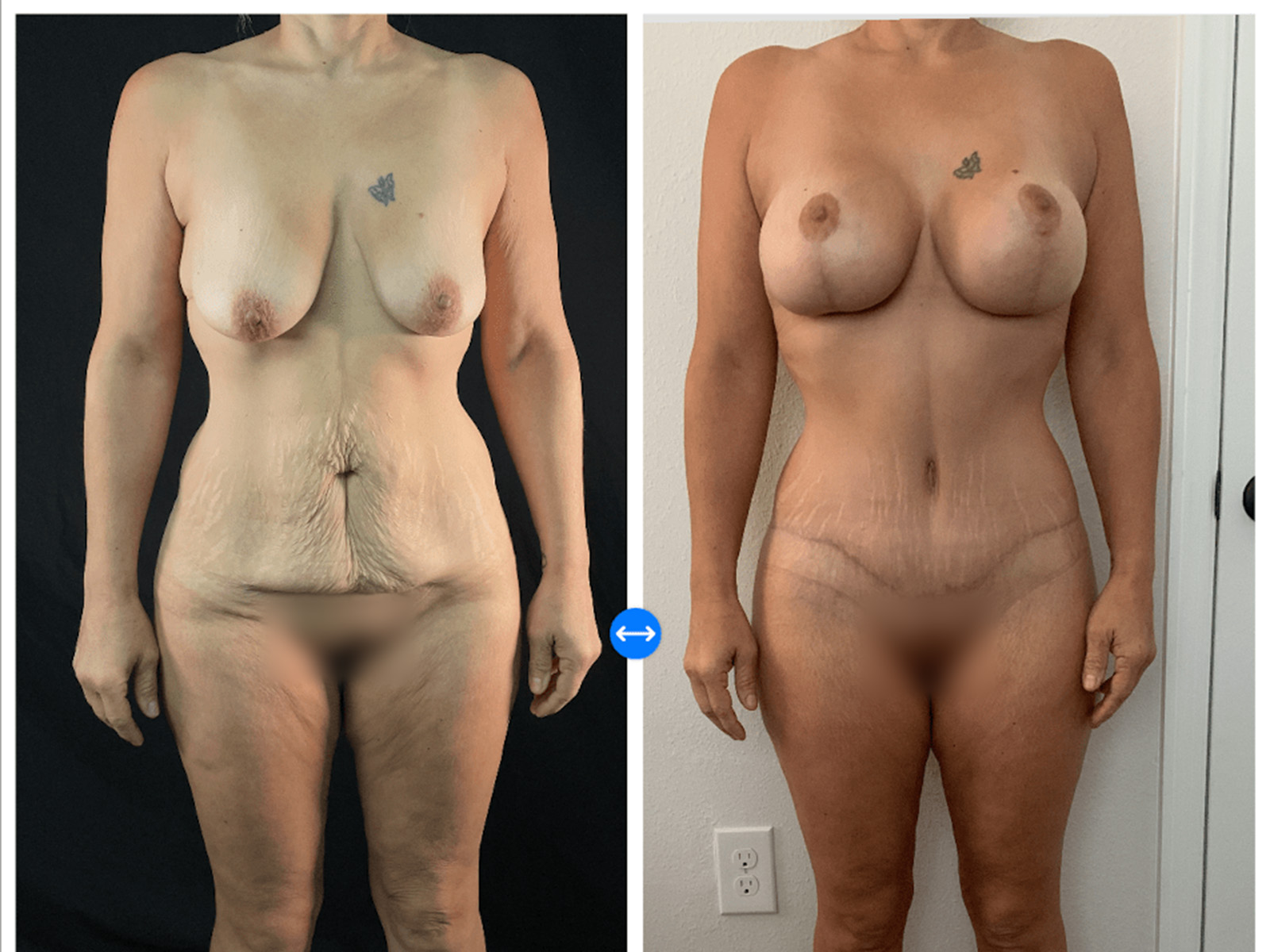 Mommy Makeover Before & After Gallery - Patient 133183632 - Image 5