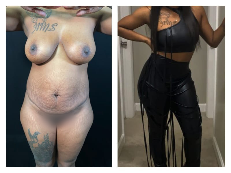 Tummy Tuck Before & After Gallery - Patient 133183929 - Image 1