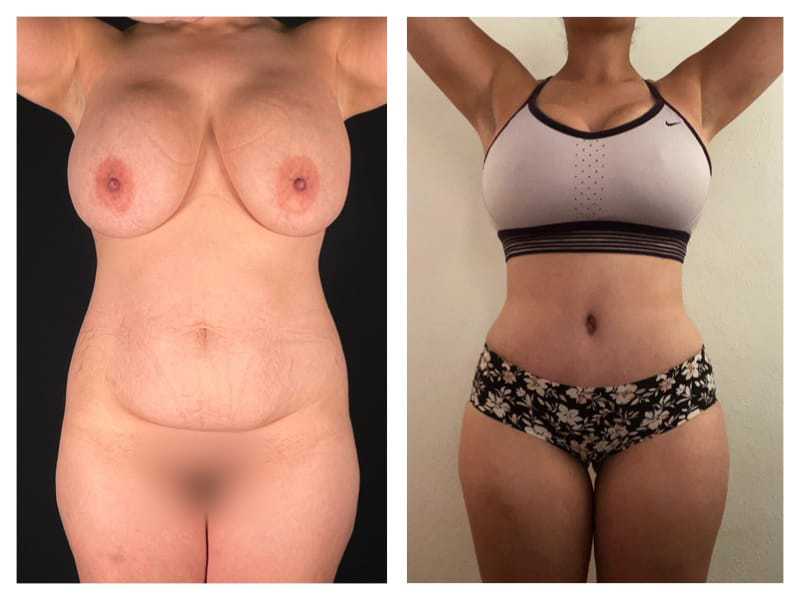 Tummy Tuck Before & After Gallery - Patient 133183638 - Image 1