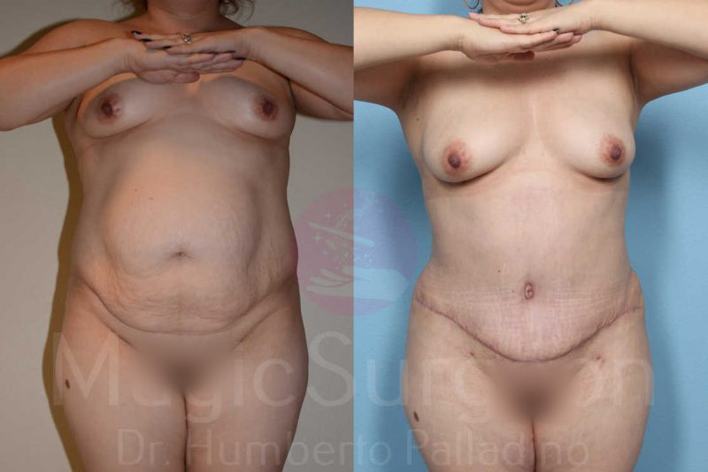 Tummy Tuck Before & After Gallery - Patient 133182323 - Image 1