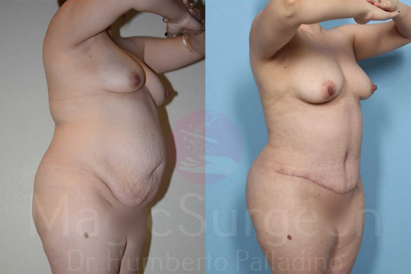 Tummy Tuck Before & After Gallery - Patient 133182323 - Image 4