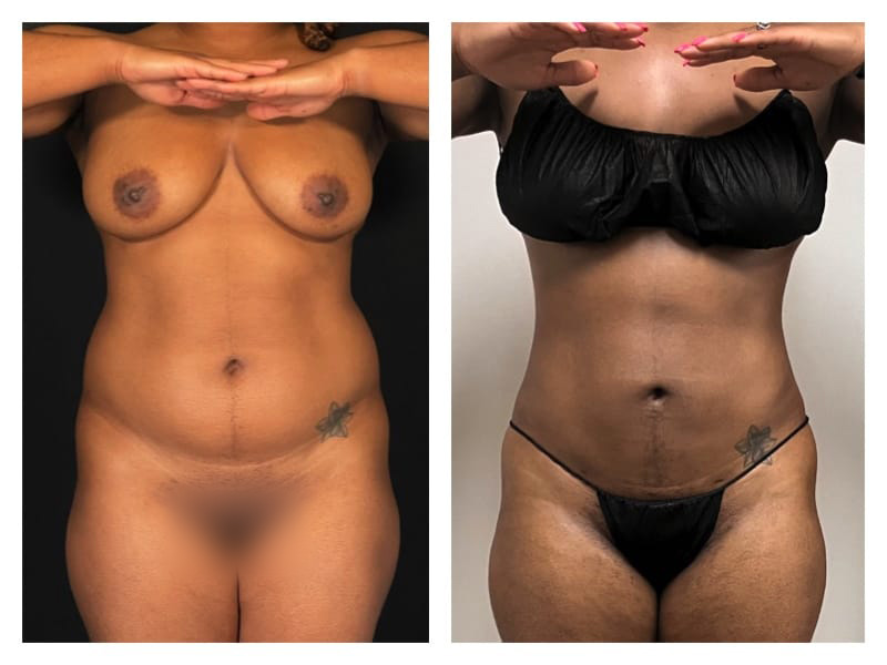 Liposuction Before & After Gallery - Patient 133183911 - Image 1