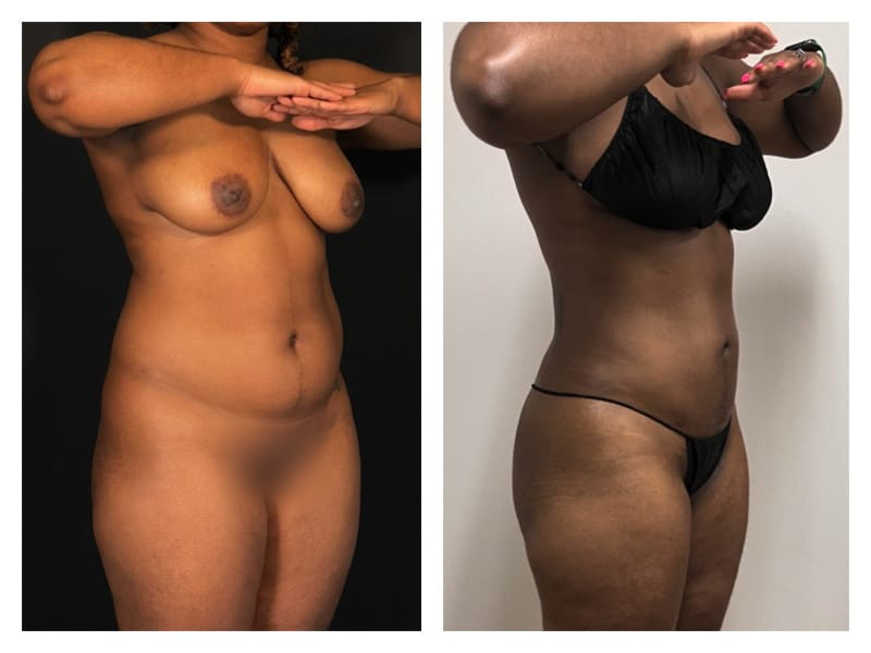 Liposuction Before & After Gallery - Patient 133183911 - Image 2