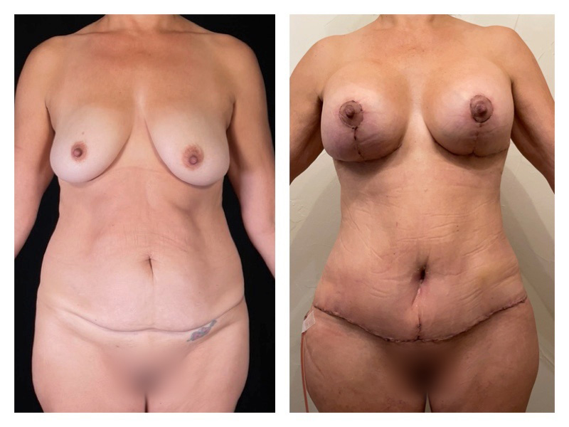 Breast Augmentation Before & After Gallery - Patient 291942 - Image 1