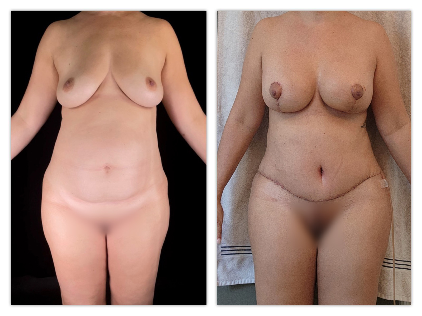 Breast Augmentation Before & After Gallery - Patient 115255 - Image 1